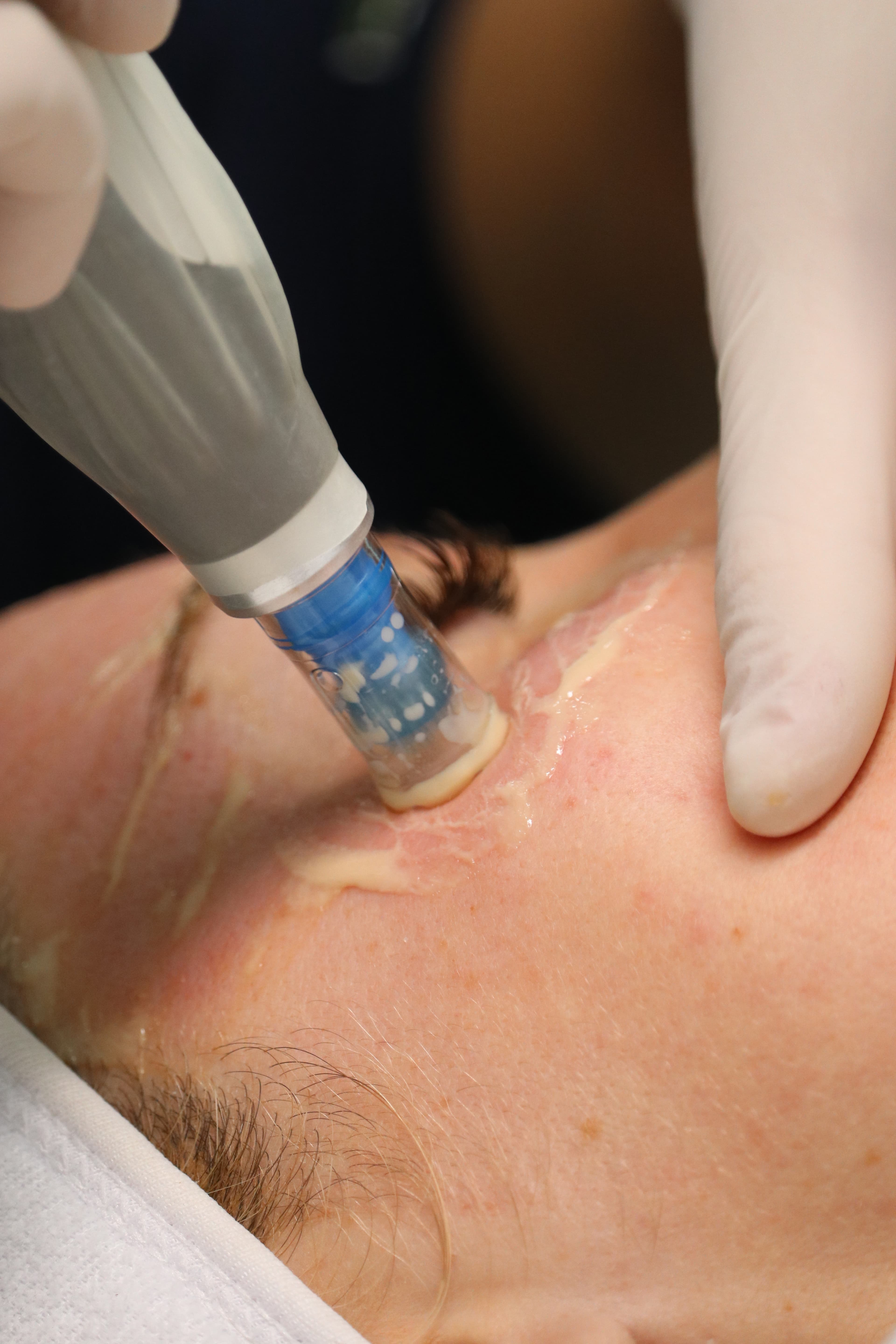 Trajtimi Dermapen 4 në MCL Aesthetic Clinic